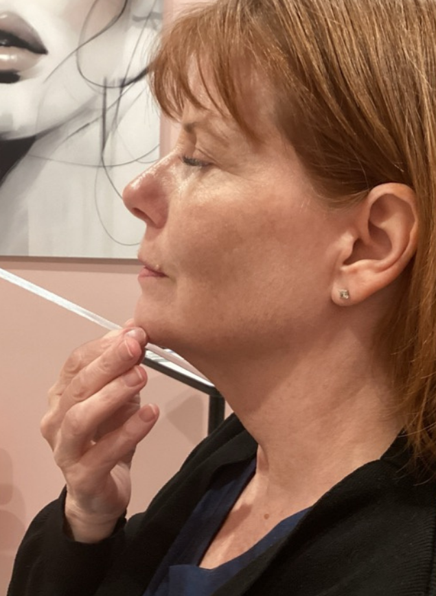 Before Kybella treatment at Let's Face It Med Spa