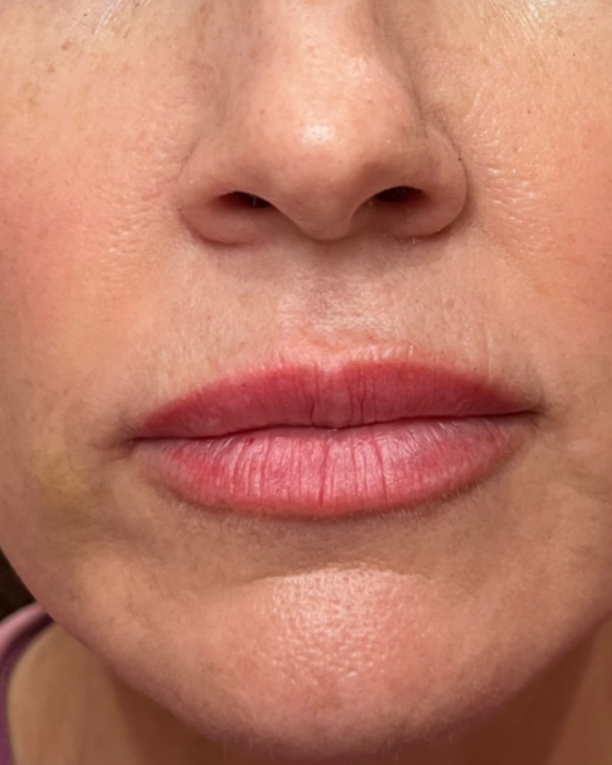Before dermal filler treatment at Let's Face It Med Spa