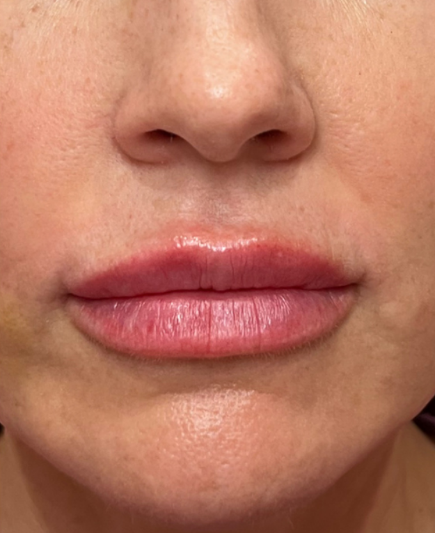 After dermal filler treatment at Let's Face It Med Spa
