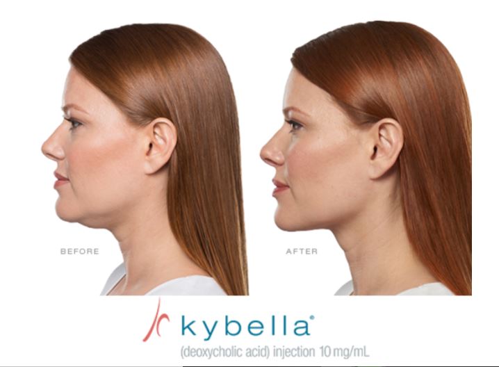 Kybella jawline contouring results at Let's Face It Med Spa in Denver.