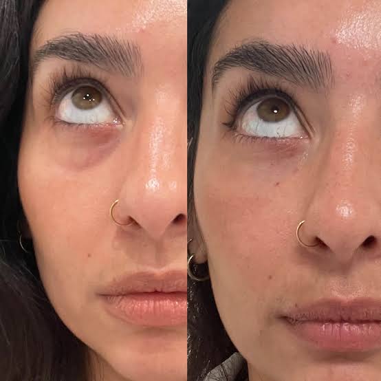 PRP treatment results at Let's Face It Med Spa in Denver.